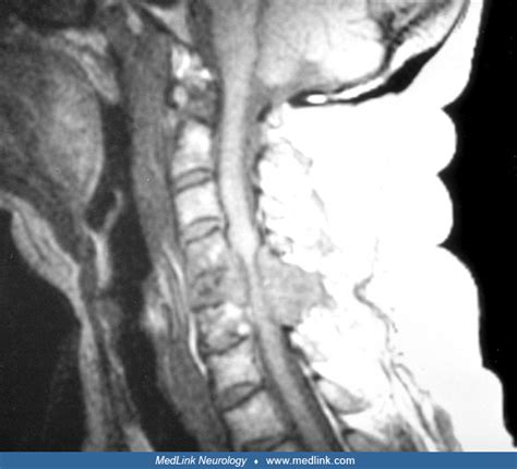 Severe Metastatic Epidural Spinal Cord Compression Mri Medlink