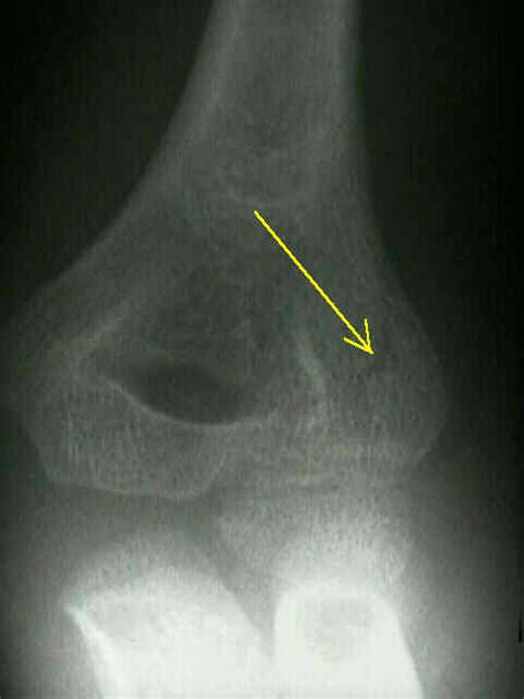 Lateral Femoral Condyle Fracture