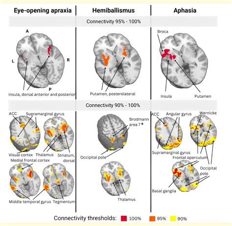 Figure 1 From Lesion Network Mapping Of Eye Opening Apraxia Semantic Scholar