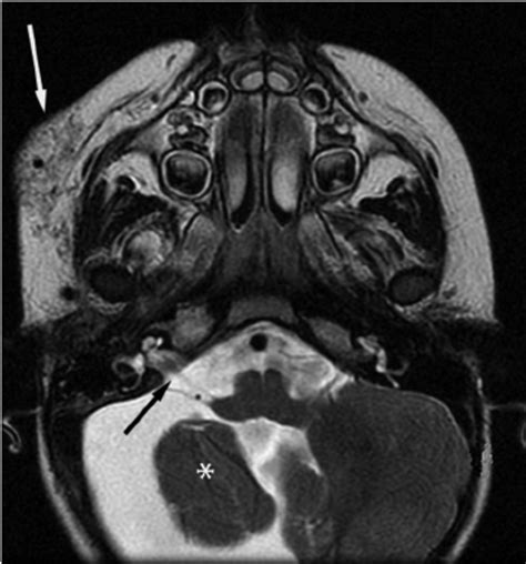 Mr Imaging Of The Same Adult Patient As In Fig 1 Axial T2 Weighted