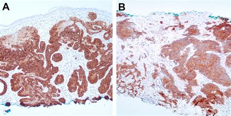 A And B Basal Cell Carcinoma And Merkel Cell Carcinoma Diffusely