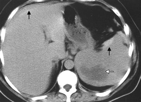 Imaging Guided Percutaneous Splenic Biopsy Using A 20 Or 22 Gauge Cutting Edge Core Biopsy