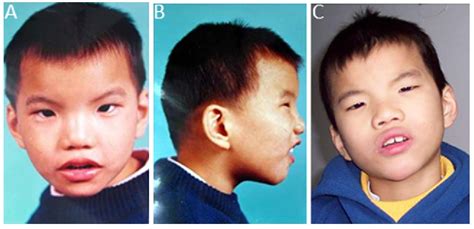 Figure 1 From A Familial Cri Du Chat5p Deletion Syndrome Resulted From