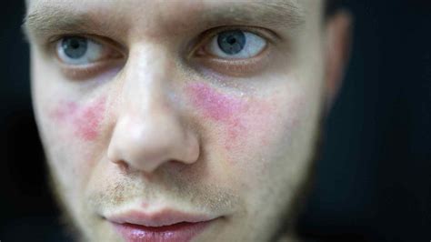 Lupus Rash Vs Rosacea Understanding Malar And Butterfly Rashes Dermeleve®