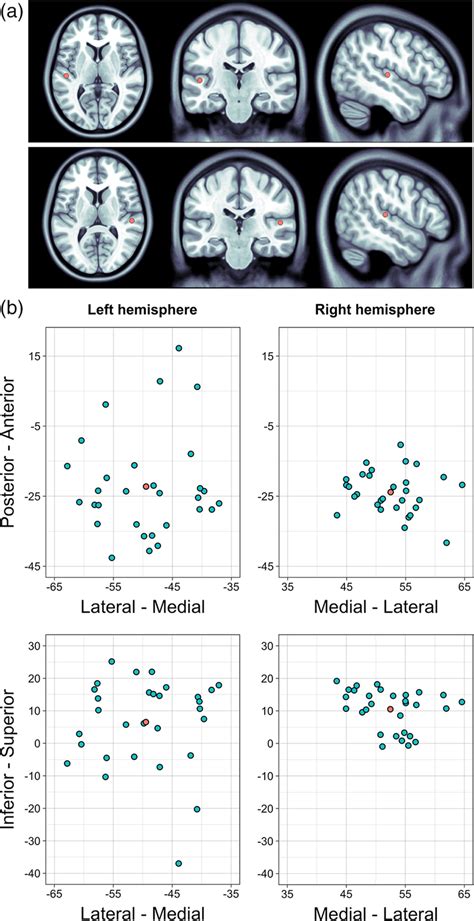 The Localization Of 40 Hz Auditory Steady‐state Response Assr In Mni