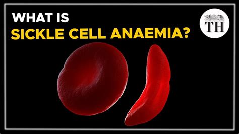 What Is Sickle Cell Anaemia The Hindu Youtube