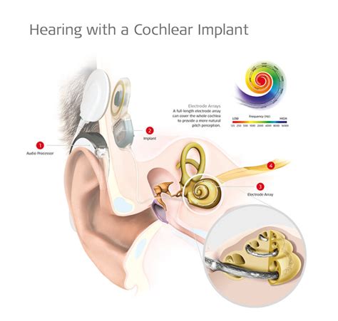 Was Ist Ein Cochlea Implantat The MED EL Blog