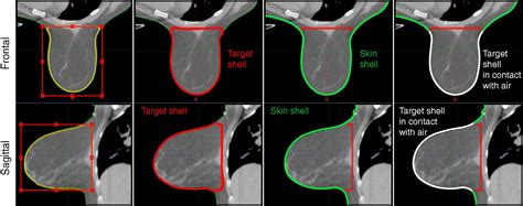 Automatic Segmentation Of Breast In Prone Position Correlation Of