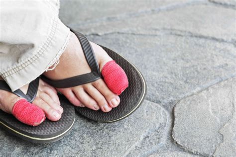 Ingrown Toenail (Onychocryptosis): Symptoms & Treatment