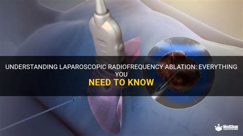 Understanding Laparoscopic Radiofrequency Ablation Everything You Need