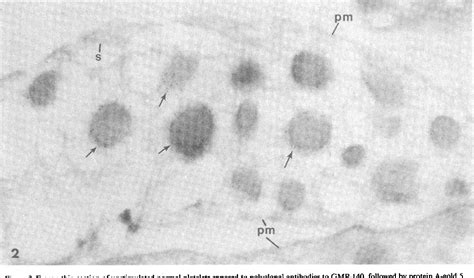 Figure 1 From Gray Platelet Syndrome Demonstration Of Alpha Granule