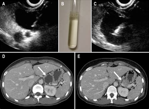 Endoscopic Ultrasonography Eus Guided Pancreatic Cystic Tumor Download Scientific Diagram