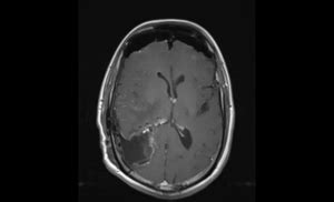 Glioma Cosa è e sintomi Dott Paolo Ferroli