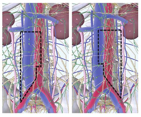 Robot Assisted Retroperitoneal Lymph Node Dissection Template Limits