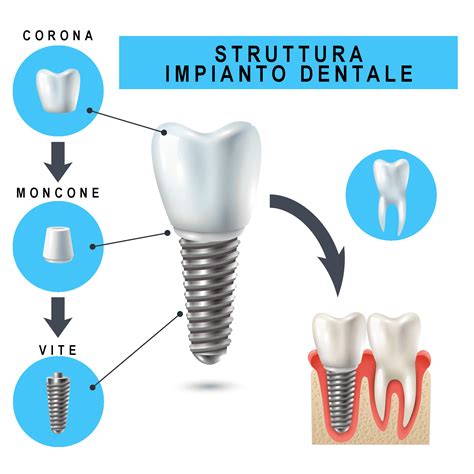 Costo impianto dentale a Roma - Dentista Roma Appia