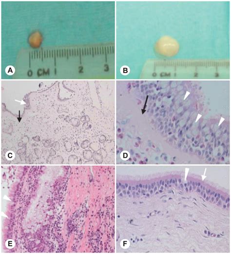 Histology Of Nasal Polyp Xenograft Tissue At 12 Weeks After