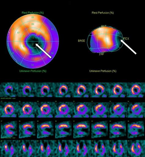 Myocardial Perfusion Scintigraphy With Mtc Mibi Of Patient From The