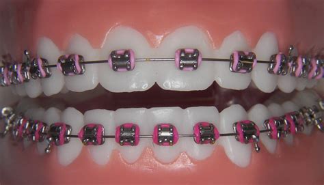 Retainer Designs And Colors Like Brace