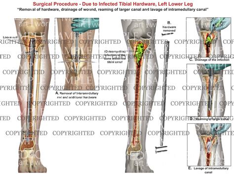 Intramedullary Rod Tibia