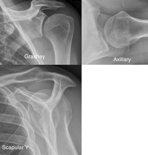 Arthroscopic Bony Bankart Lesion Fixation Using Knotless Double Loaded Suture Anchors And