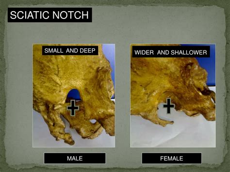 Ppt Sex Determination From Human Skeletal Remains { Skull Pelvis Sternum } Powerpoint