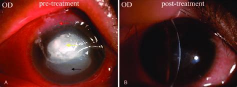 A Diffuse Superficial Conjunctival Congestion Gelatinous Hyperplasia Download Scientific