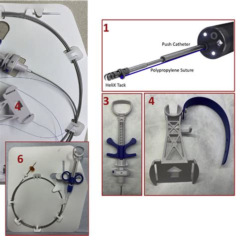 Pdf Step By Step Instruction Using An Endoscopic Tack And Suture Device For Gastrointestinal