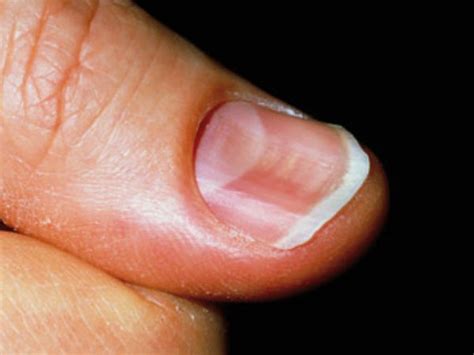 Spoon Shaped Concave Nails Causes And Mechanisms Of Pathogenesis Vinmec