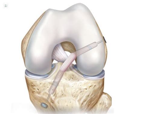 Ortopedia Traumatolog A Artroscopia Manejo Del Dolor