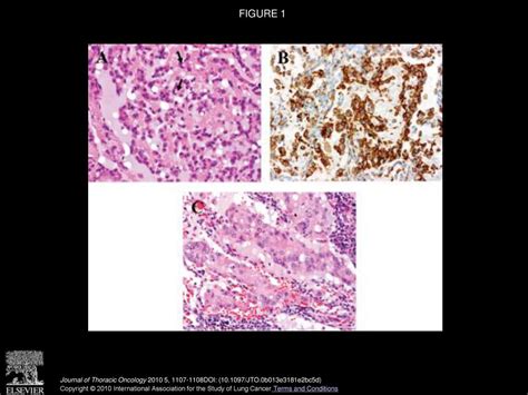 Treatment Of Pulmonary Epithelioid Hemangioendothelioma With