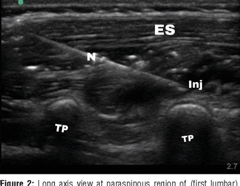 Figure 2 From Ultrasound Guided Erector Spinae Versus Ilioinguinal