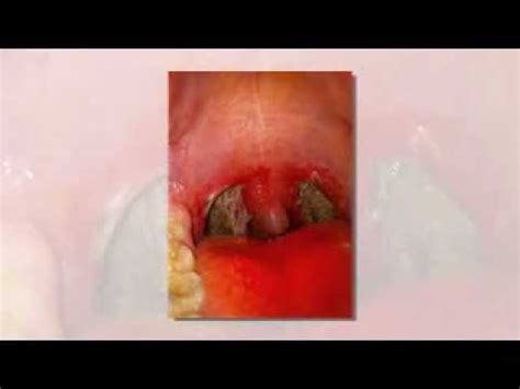 Swollen Uvula Top 7 Pictures Of Swollen Uvula YouTube