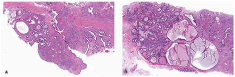 Fibroepithelial Neoplasms Basicmedical Key