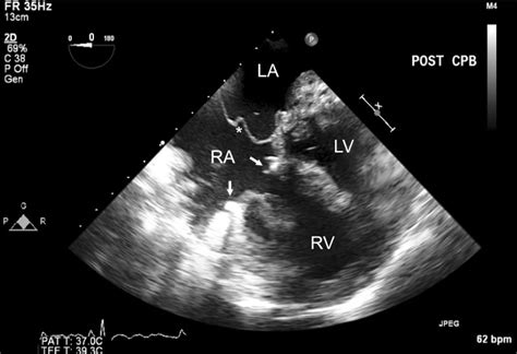 Postprocedural Two Dimensional Transesophageal Echocardiography