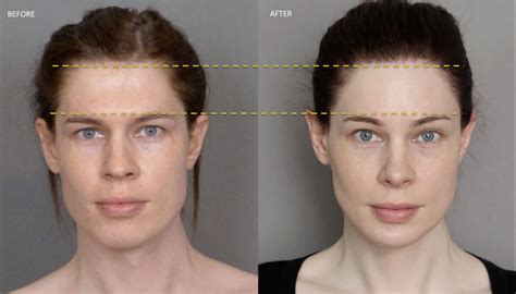 Male Into Female Facial Feminization Telegraph