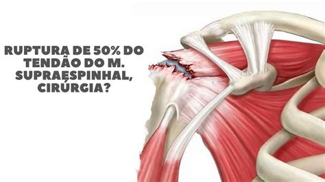 Ruptura De 50 Do Tendão Do Músculo Supraespinhal Cirúrgia Youtube