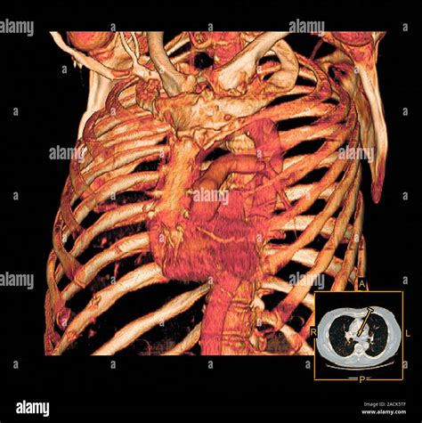 Coloured Three Dimensional 3D Computed Tomography CT Scan In