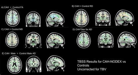 Results From The Tbss Analyses Using Tfce Threshold Corrected For Sex Download Scientific