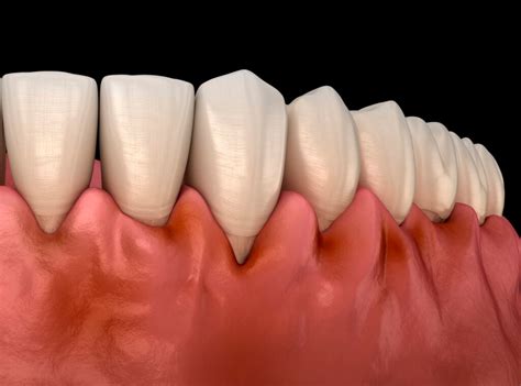 Swollen Gums Causes Symptoms Treatment