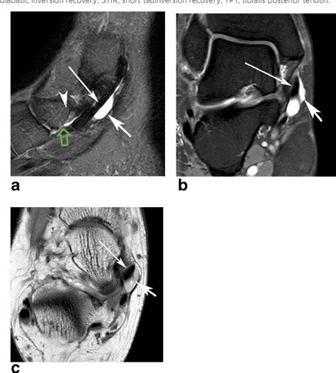 Tibialis Posterior Tendon Mri