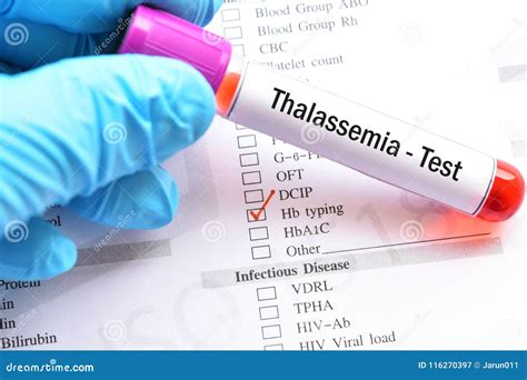 Thalassemia test stock image. Image of analyzing, carrier - 116270397