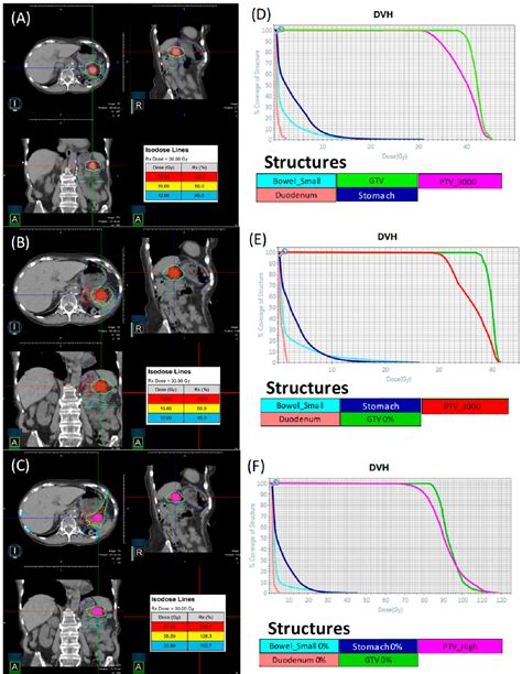 Figure 1 From Investigation Of Isotoxic Dose Escalation And Plan