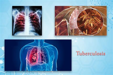 Tuberculosis Tb Specialist Treatment In Chennai