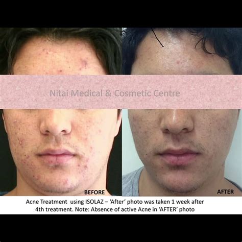 Isolaz Acne Therapy Melbourne Nitai Cosmetic Clinic