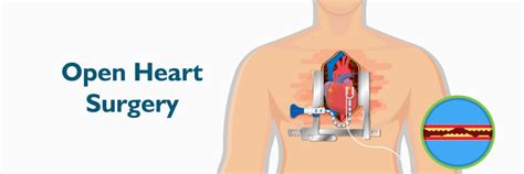 Open Heart Surgery: Benefits, Risks and Recovery