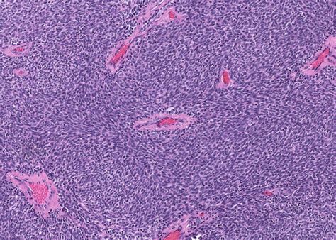 Pathology Outlines Myoepithelial Carcinoma