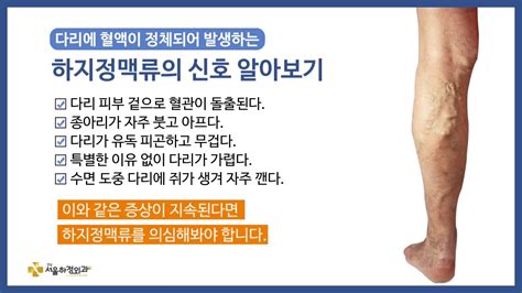 하지정맥류의 대표적인 증상 알고 계신가요 Youtube