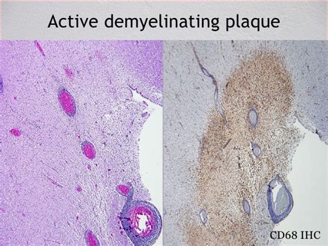 Pathology Of Demyelinating Disease