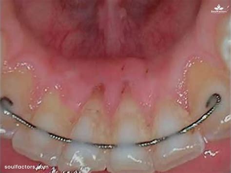 How Much Is A Snake Eyes Piercing Budgeting For Style