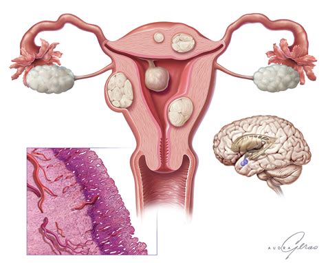 Uterine Fibroids - Geras Healthcare Productions